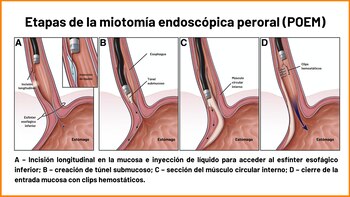 La técnica POEM es mínimamente