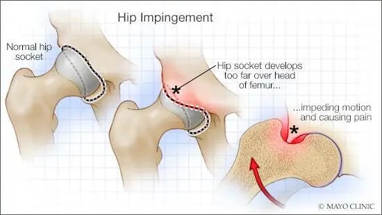En una cadera normal, la cabeza del fémur se mueve sin trabas dentro de la cavidad de la pelvis. En el pinzamiento, el borde de esa cavidad cubre demasiado al hueso y hace que ambas partes choquen al mover la pierna, lo que puede limitar el movimiento y causar dolor (Créditos: Mayo Clinic)