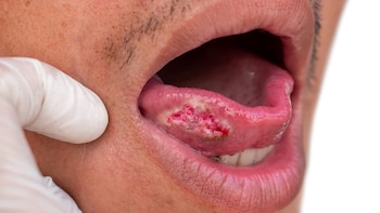 Nueva prueba de cepillado altamente precisa puede detectar cáncer de boca en menos de una hora