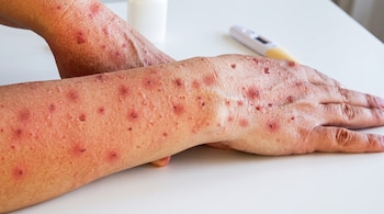 Brazo y mano con sarpullido rojo, termómetro digital y envase blanco sobre mesa blanca.