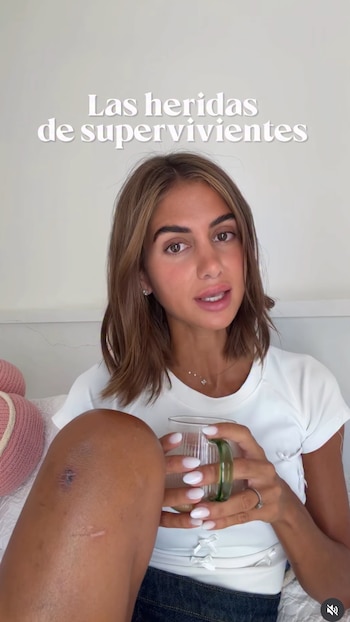 Maica Benedicto ha mostrado las heridas de sus piernas. (Instagram @maiibenedicto)
