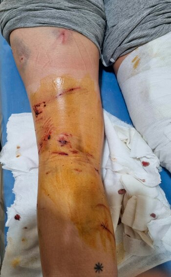 La víctima resultó con múltiples