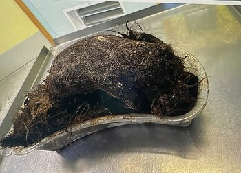 El tricobezoar es una masa