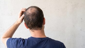 Qué factores determinan la caída del cabello en los hombres y por qué suele avanzar con los años