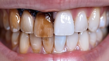 Manchas negras en los dientes