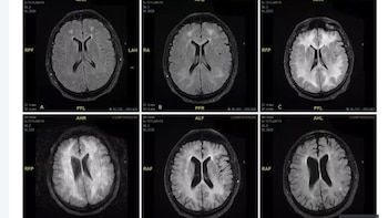 La droga actúa como “exprimiendo”