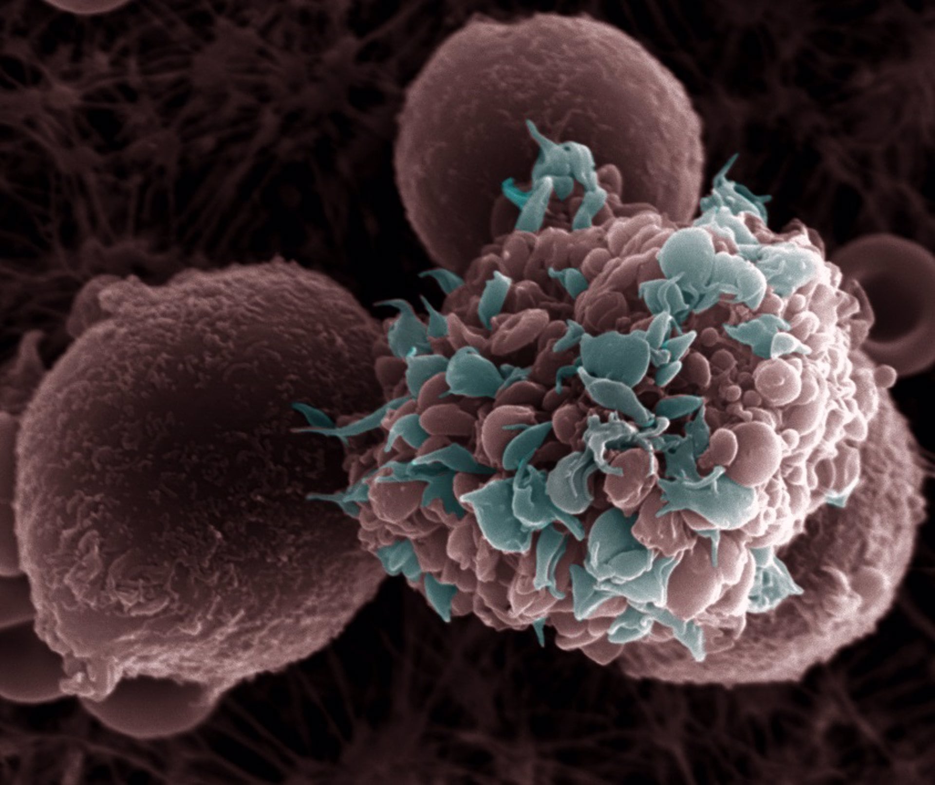 Desde su aprobación clínica en 2017, la terapia CAR-T ha transformado el tratamiento de leucemia linfoblástica aguda y linfomas, aunque persisten desafíos en tumores sólidos (Europa Press)