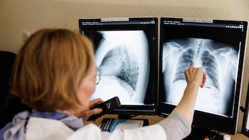 La Junta confirma tuberculosis en dos trabajadores de una explotación en Segovia, uno de los cuales ha fallecido