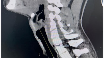 El paciente sufría una estenosis traqueal severa, consecuencia de una intubación prolongada y traqueostomía posteriores a una herida de bala hace dos años - Créditos: Essalud.