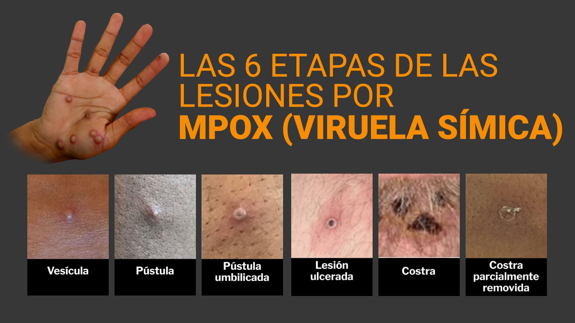 La viruela símica puede transmitirse a los seres humanos por contacto físico con personas infectadas, materiales contaminados o animales infectados /Infobae
