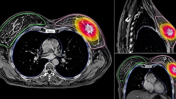Una radioterapia de cinco días y mínimo volumen muestra resultados favorables en pacientes con cáncer de mama precoz