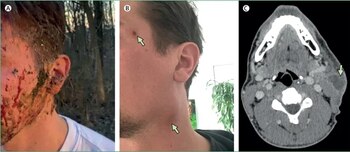 (A) Fotografía tomada el día del accidente que muestra la exposición facial a sangre del ciervo, otros fluidos corporales del animal y tierra. (B) Fotografía tomada el día 24 tras el accidente; la flecha inferior señala una inflamación cervical cerca del ángulo mandibular izquierdo y la flecha superior indica una lesión periorbitaria. (C) Tomografía computarizada (TC) cervical axial con contraste realizada el día 30 tras el accidente; la flecha señala un absceso representativo de múltiples lesiones en el lado izquierdo.