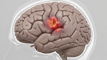 Derrame cerebral y accidente cerebrovascular: