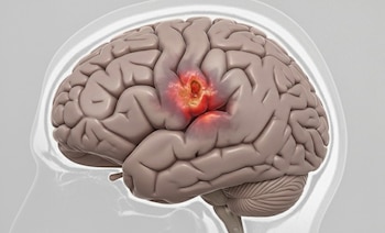 El ACV es una interrupción