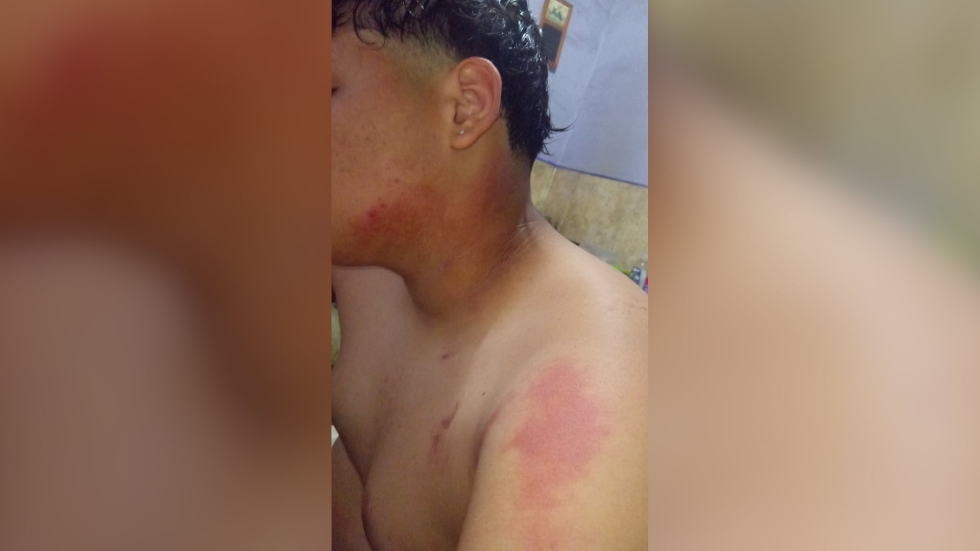 La víctima sufrió quemaduras en el cuello, hombro, brazo y mano izquierdos.