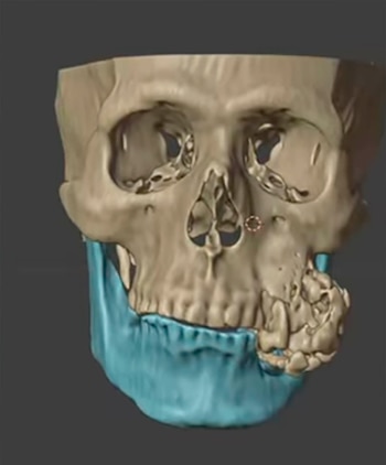 El equipo médico determinó que el osteofibroma era un tumor óseo benigno, aunque su crecimiento comprometió el maxilar superior (Captura de video: YouTube)