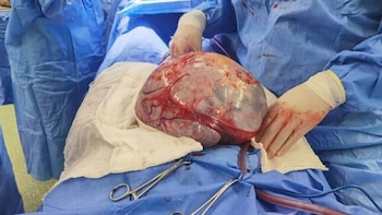 Tumor fue extirpado en una