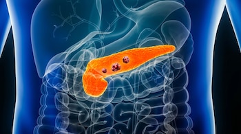 Ilustración digital de un páncreas naranja brillante con formaciones celulares rojas dentro de un cuerpo humano translúcido azul y negro.