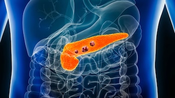 Avance clave contra el cáncer de páncreas: prueban un fármaco que interfiere en el crecimiento del tumor