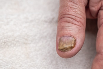 5 señales sutiles de que el cuerpo necesita más nutrientes, según un médico de Harvard 9 Las uñas quebradizas pueden indicar una deficiencia de proteínas e hierro debido a la falta de alimentos ricos en queratina