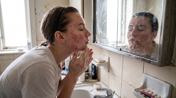 Una persona joven con acné, manos enjabonadas en el rostro, se mira en un espejo sobre un lavabo con un grifo y productos de higiene.
