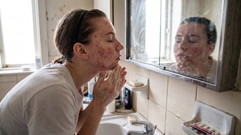 Errores al lavar el rostro que empeoran el acné