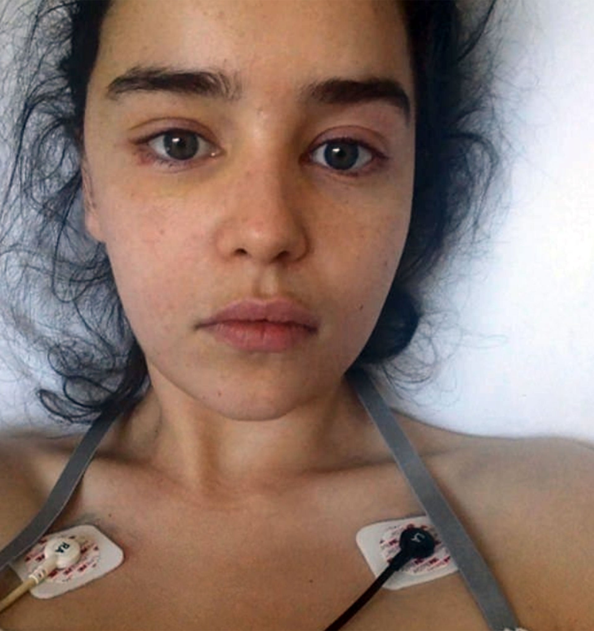 Además de hablar sobre su duelo, Emilia Clarke también abordó las secuelas de sus aneurismas cerebrales y otros problemas de salud (Archivo)