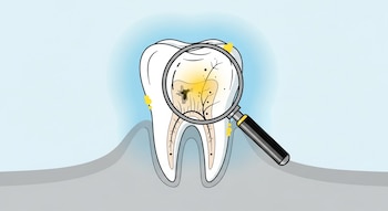 Ilustración plana de una muela blanca con un aura azul claro. Una lupa revela caries oscuras y fisuras en su interior, con puntos amarillos alrededor. Fondo liso.