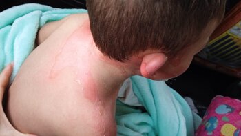 Familia denunció que su hijo de dos años de edad resultó con quemaduras de segundo grado en un jardín de Bogotá