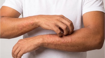 Parte superior de una persona con camiseta blanca. Dos antebrazos de piel morena presentan ronchas rojizas y blanquecinas. Una mano rasca un antebrazo.