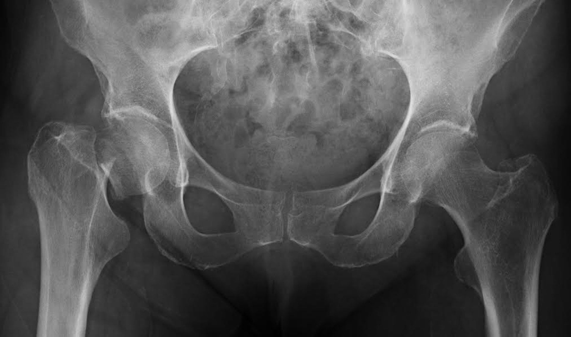 14/09/2015 Investigadores del Instituto de Investigación Marqués de Valdecilla y de la Universidad de Cantabria integrados en un equipo internacional han participado en la identificación de un gen que está implicado en la osteoporosisSALUD ESPAÑA EUROPA CANTABRIAUNIVERSIDAD DE CANTABRIA