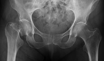 14/09/2015
Investigadores del Instituto de Investigación Marqués de Valdecilla y de la Universidad de Cantabria integrados en un equipo internacional han participado en la identificación de un gen que está implicado en la osteoporosis
SALUD ESPAÑA EUROPA CANTABRIA
UNIVERSIDAD DE CANTABRIA