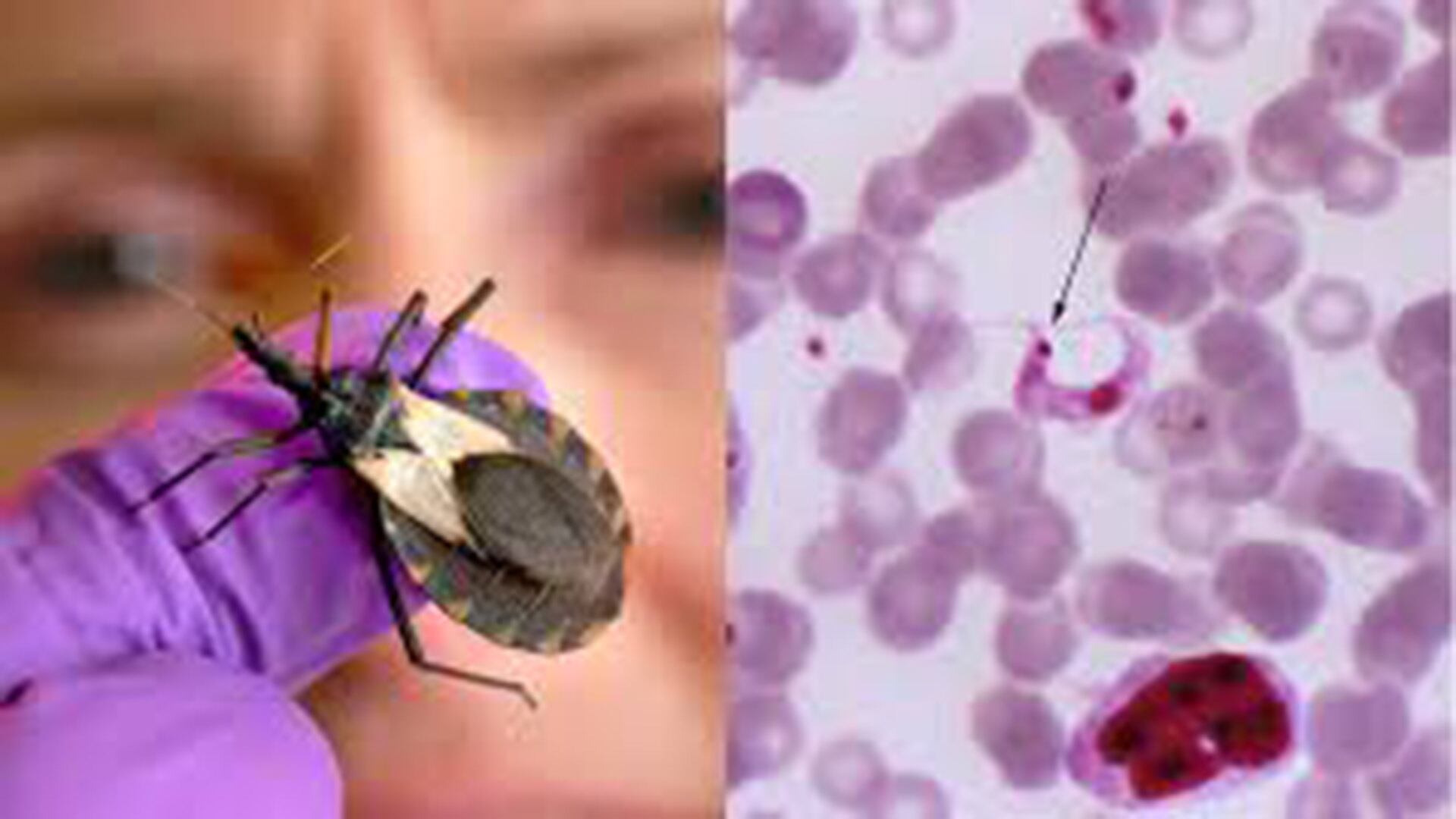 Expertos recomiendan capacitar al personal médico y aplicar protocolos de tamizaje en bancos de sangre y maternidades para prevenir Chagas/ CDC