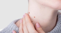 Cómo eliminar las verrugas del rostro, cuello y manos con vinagre de manzana de forma natural y segura