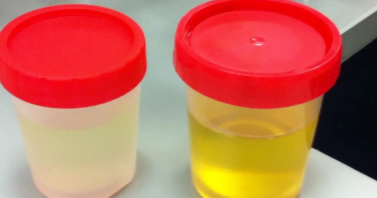 ¡Orina Cristalina! ¿Es Buena Señal o Deberías Preocuparte? Descubre la Verdad