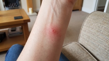 Antebrazo de persona con zona enrojecida e inflamada por una perforación. Se observa la pierna con pantalón vaquero, un sofá y una mesa de madera.