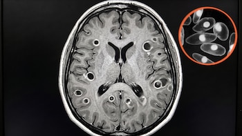 Gusanos en el cerebro: uno de cada tres humanos carga un parásito