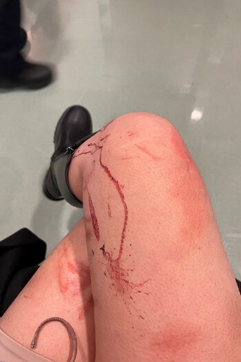 Los rasguños y moretones le