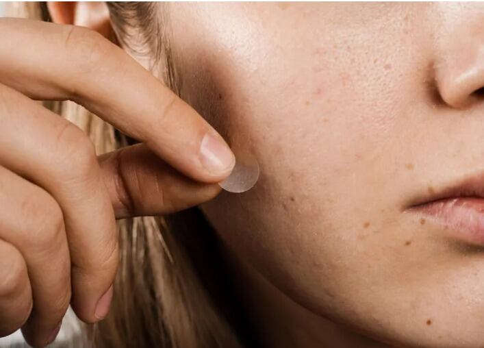 Los parches para granos absorben pus y sebo, protegiendo la piel de infecciones y evitando la manipulación de las lesiones (captura de video)