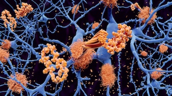 Ilustración de ramificaciones neuronales en color azul y acumulaciones de proteína en color naranja sobre un fondo oscuro.