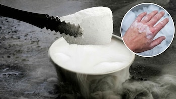Quemadura con hielo seco: qué