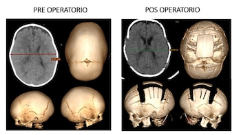 La escafocefalia, aunque es una