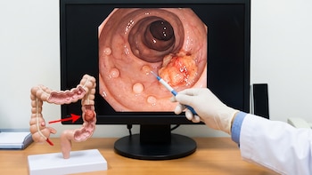Pólipos en intestino y cáncer: ¿cuál es la conexión?