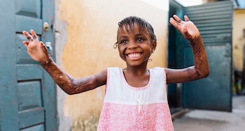 Esta niña sufrió quemaduras cuando