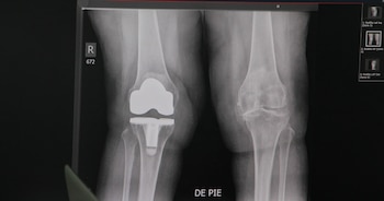 En etapas avanzadas la cirugía consiste en reemplazar el cartílago articular desgastado por prótesis de metal y plástico.