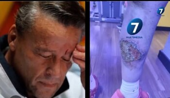 El actor mostró su herida