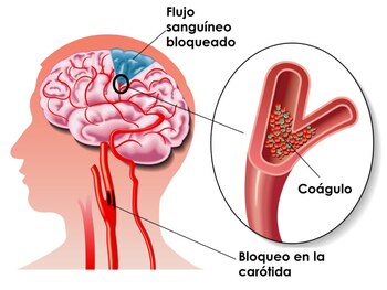 El infarto cerebral se presenta