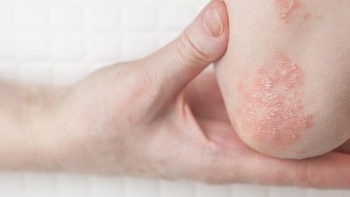 Las enfermedades autoinmunes como el lupus y la psoriasis pueden aumentar el riesgo de cáncer