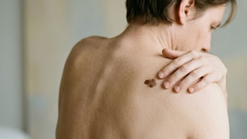 Reino Unido registra un máximo histórico de casos de melanoma y alerta por una ola de calor inminente