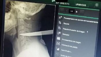 Sobrevivió con un cuchillo clavado